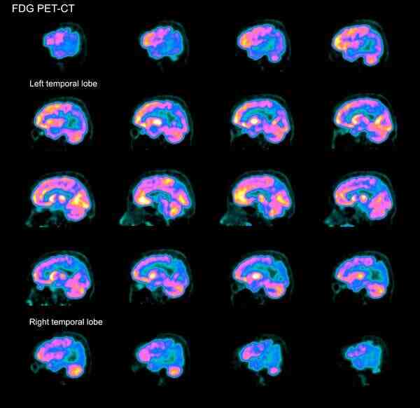 Lee más sobre el artículo Tecnología de Harvard para mejorar la memoria y prevenir la demencia